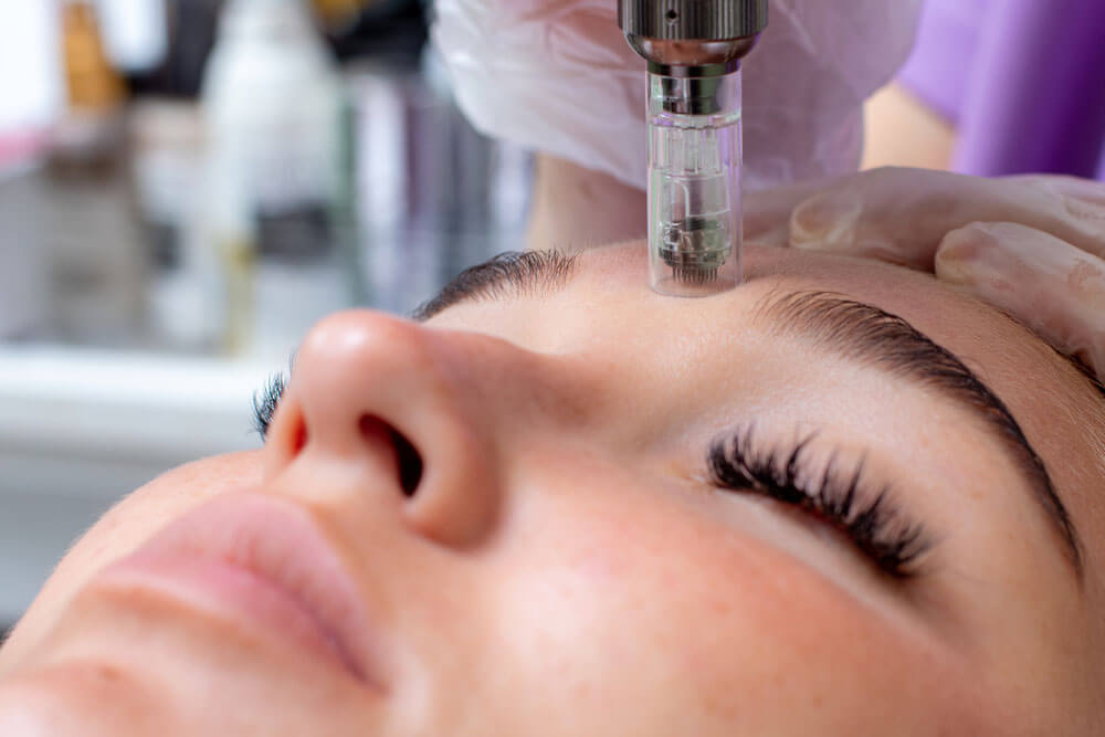 Optimal Health and Wellness Aesthetics Microneedling