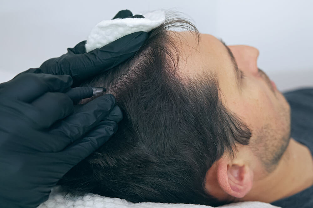 Optimal Health and Wellness Aesthetics Scalp Micropigmentation